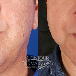 Kybella for jowls, 3 months after. 51 yr old man.
