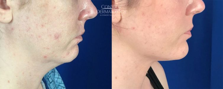 Chin Liposculpture, 1 month after, 33 year old female