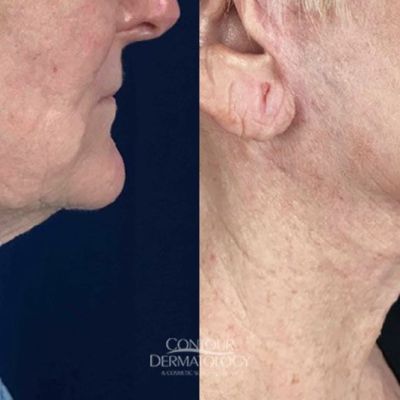 Mini-Facelift, 4 months After