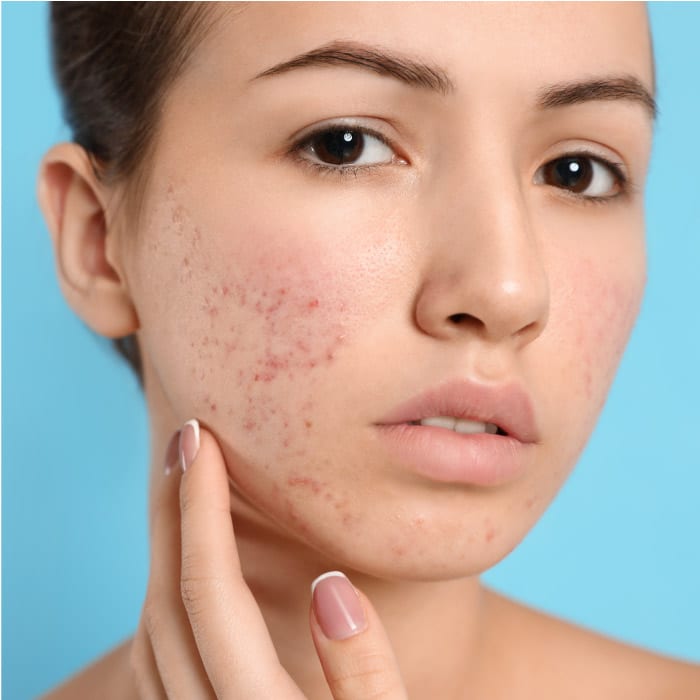 Contour Dermatology and Timothy Jochen, MD help people overcome their acne.