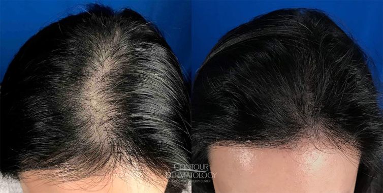 Hair Transplant Before and After – Female – 2200 Grafts
