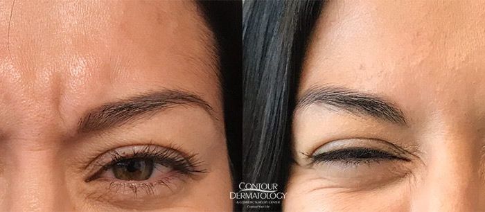 Botox for Glabella (between the eyes)