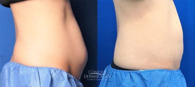 CoolSculpting for Abdomen