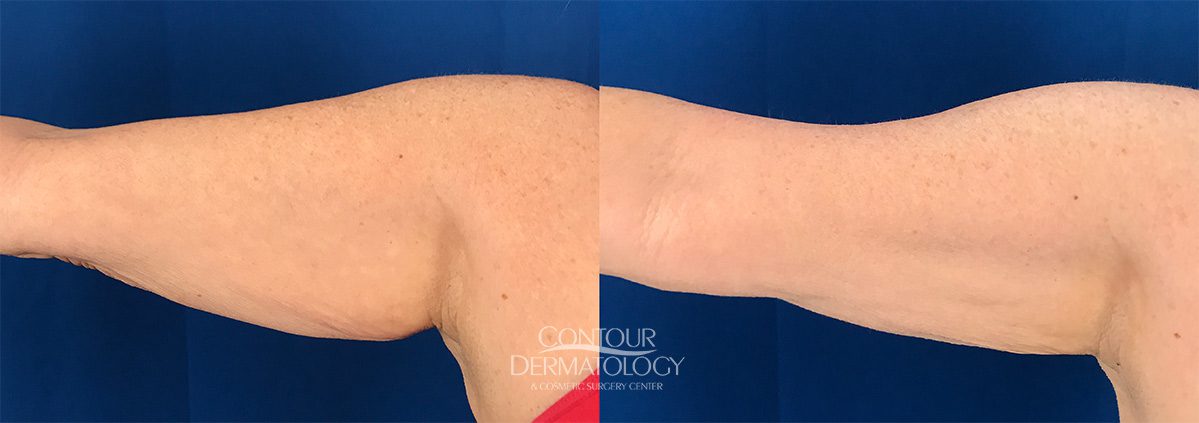 CoolSculpting Elite, reducing fat on tummy & flanks, before and after