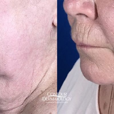 MIni Facelift and Chin Lipo Combo