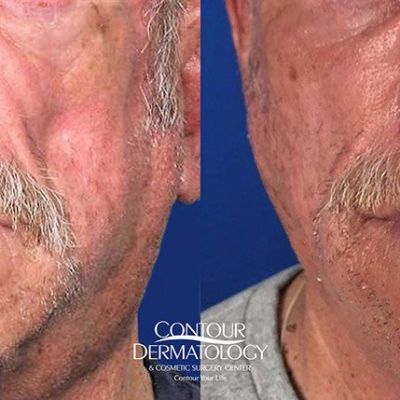 Actual Sculptra patient Contour Dermatology