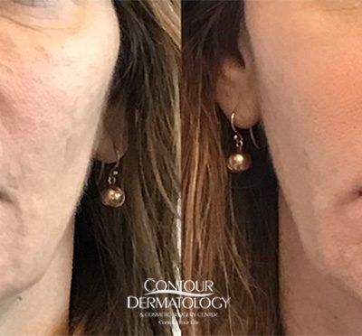 1 vial of Sculptra on the Cheeks