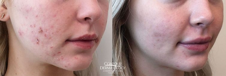Accutane, Before & After