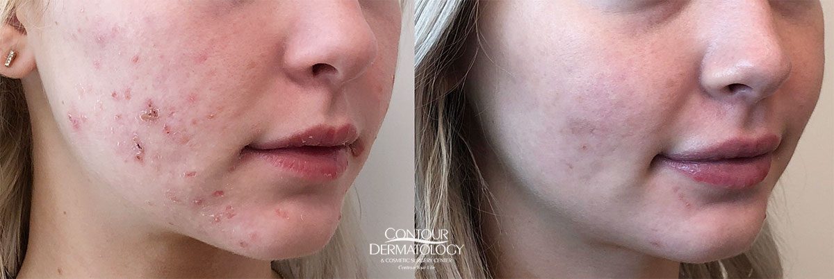 Acne Scars Treatment Before And After Photos