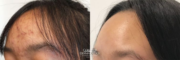 Accutane, Before & After