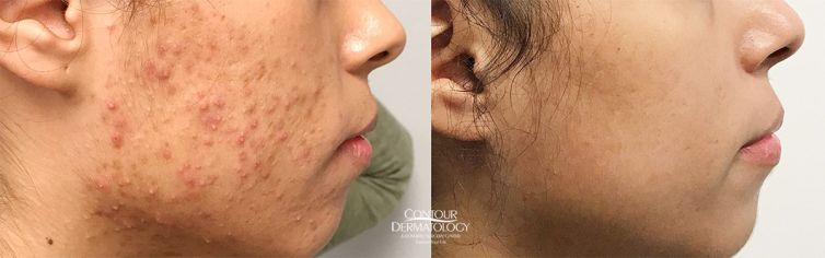 Accutane, Before & After
