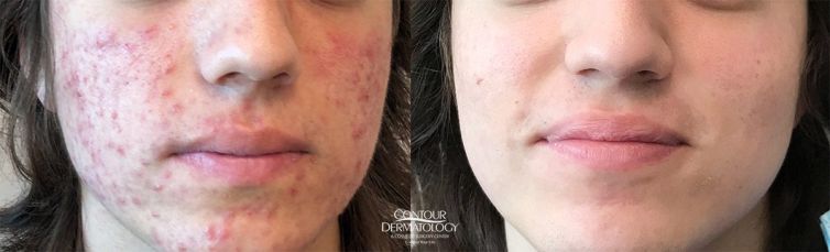 Accutane, Before & After