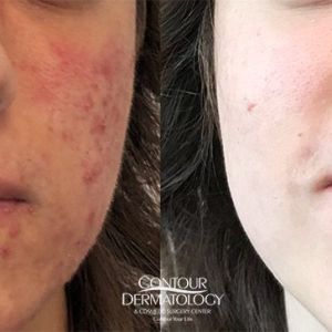 Accutane, Before & After