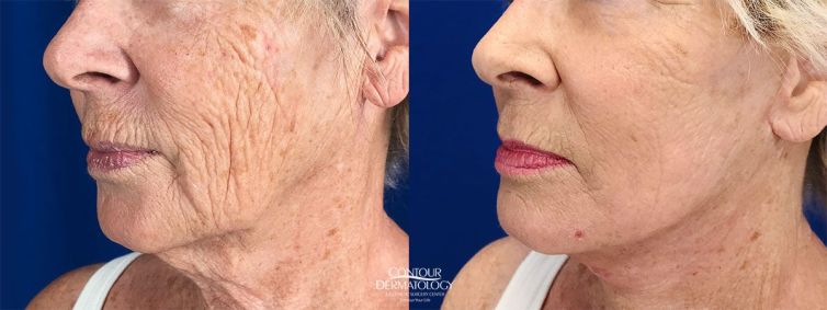 Mini Facelift with Fractional CO2 laser, 68 years old, After 1 month