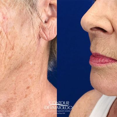 Mini Facelift with Fractional CO2 laser, 68 years old, After 1 month