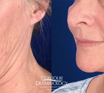 Mini Facelift, 58 years old, 2 weeks post-procedure