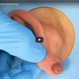 Dr. Timothy Jochen removes a keloid scar located on the by surgical excision. Keloids are raised scars that have expanded beyond the boundaries of the original wound.