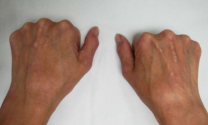 CREST limited scleroderma symptoms on the hands