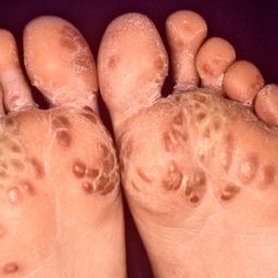 Reiter's syndrome (also known as Keratoderma Blennorrhagicum) on the feet