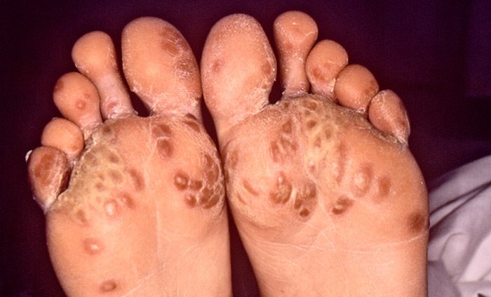 Reiter's syndrome (also known as Keratoderma Blennorrhagicum) on the feet