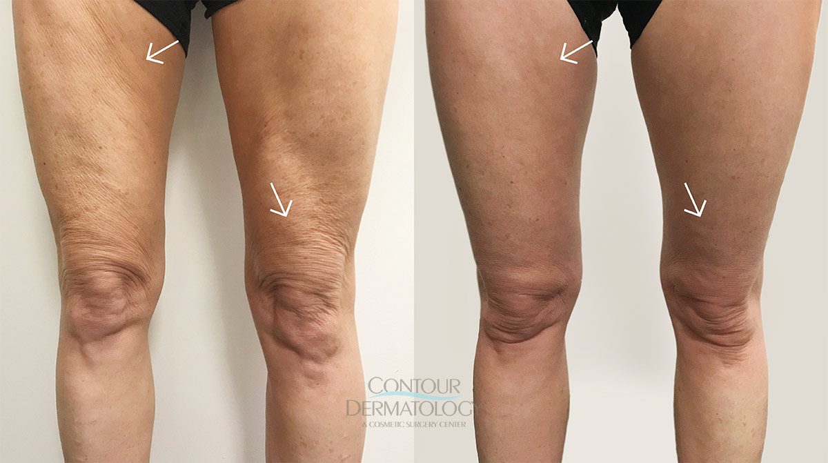 VelaShape III Legs before and after