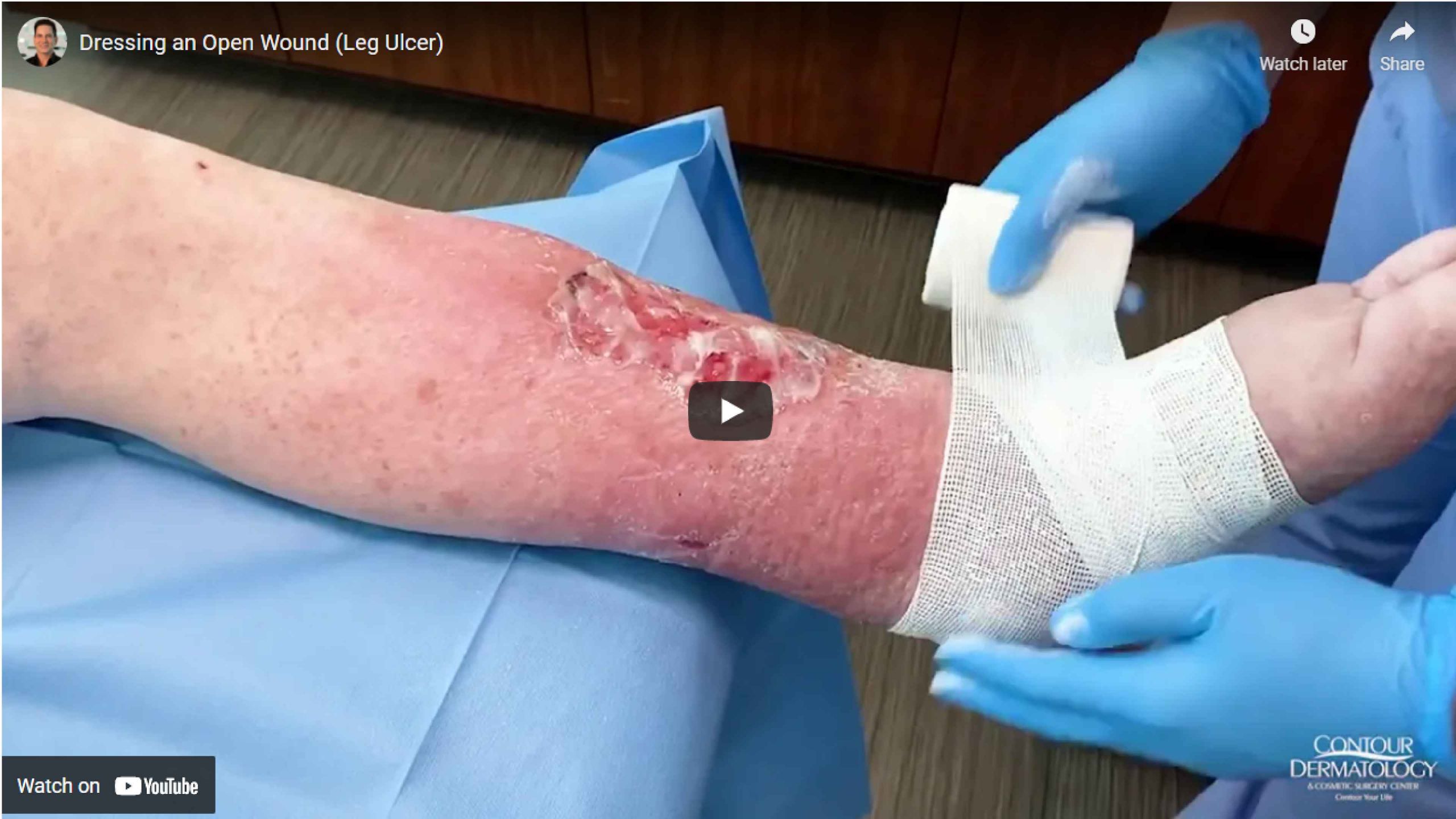 Dressing an Open Wound (Leg Ulcer) | Contour Dermatology Dressing an Open Wound (Leg Ulcer) | Contour Dermatology