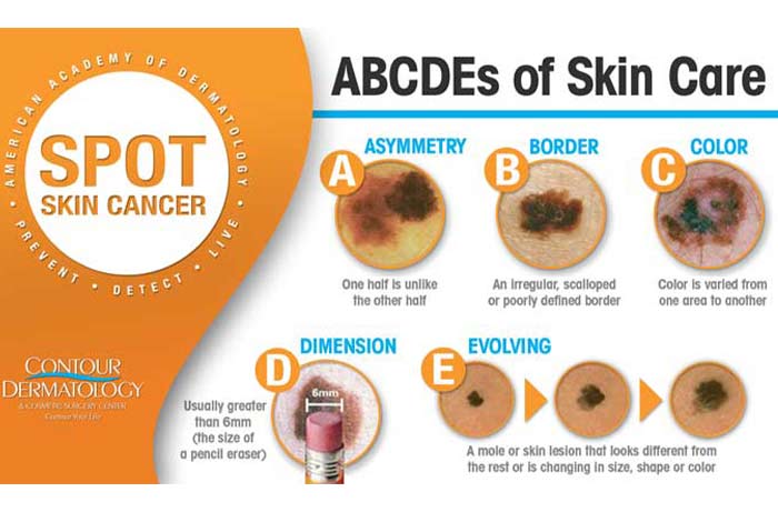 Types of Skin Cancer and how to detect them