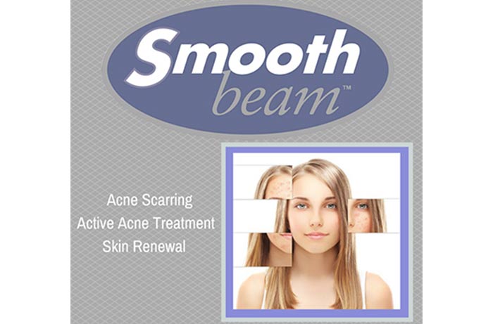 Smoothbeam laser for acne.