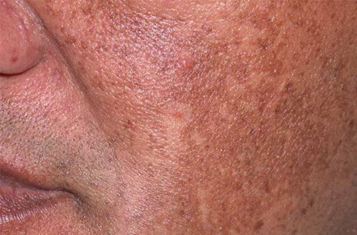 Hyperpigmentation Skin Condition Contour Dermatology