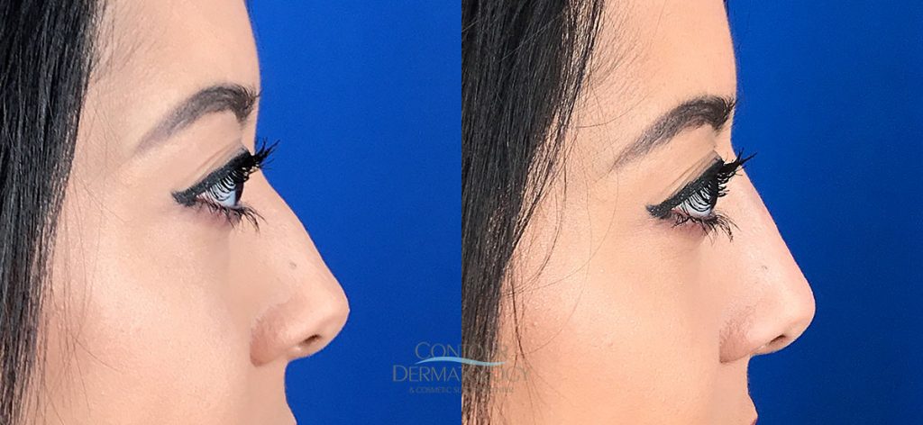 Liquid Nose FIller Before and Aftre