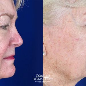 Full Face Fractional CO2, Side View, Before and After