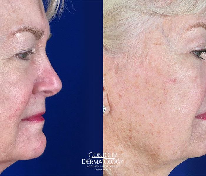Full Face Fractional CO2, Side View, Before and After