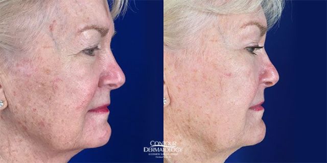 Full Face Fractional CO2, Side View, Before and After