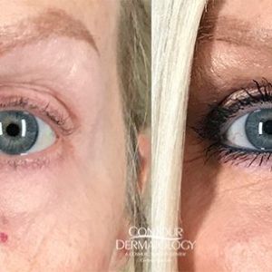 Lower Eyelid Surgery (Blepharoplasty) and CO2 Laser, 64 year old female, 1 month after