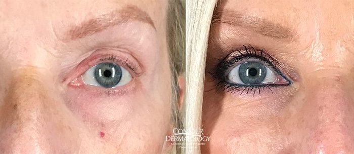 Lower Eyelid Surgery (Blepharoplasty) and CO2 Laser, 64 year old female, 1 month after
