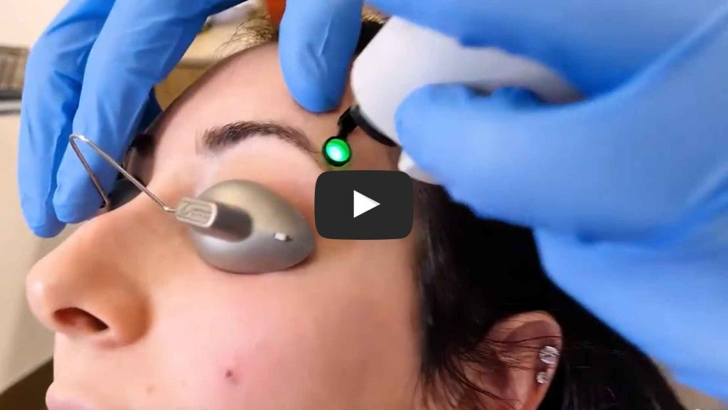 Vbeam Perfecta for Red Spots