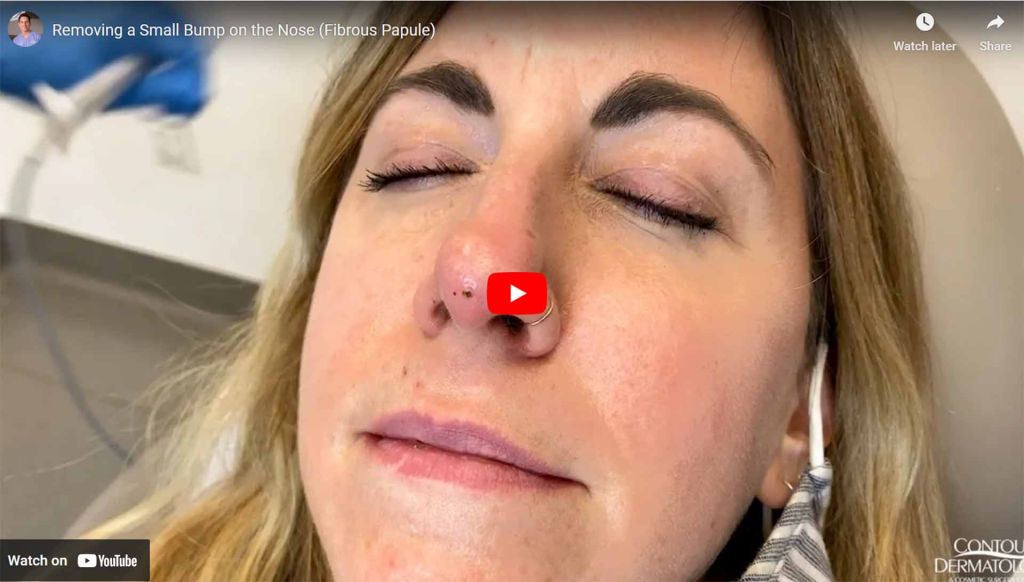 Fibrous Papule occurs in adults and is characterized by a dome-shaped, sessile, skin-colored, white, or reddish papule 3 to 6mm in diameter on or near the nose.