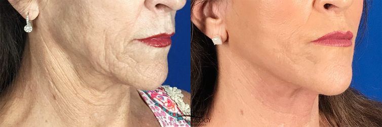 Mini Facelift, 61 years old, Before and After