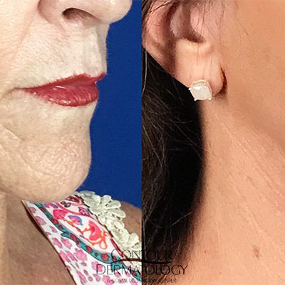 Mini Facelift, 61 years old, Before and After