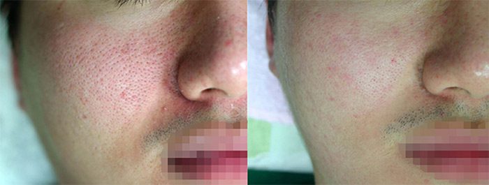Lutronic Action II, Large Pores, Before & After