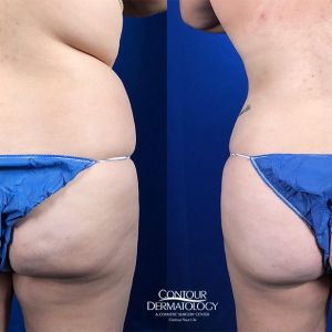 Liposuction for the Abdomen and Flanks with Fat Transfer to the Buttocks