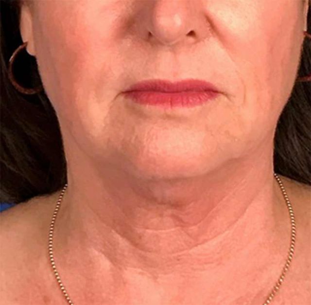 Profound Lift is a breakthrough non-surgical, single treatment for jawline and neck contouring, wrinkles and skin tone. The only procedure proven to naturally create elastin, collagen and hyaluronic acid – the building blocks that keep your skin smooth and toned.