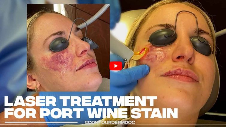 Laser Treatment for Port Wine Stain on Face
