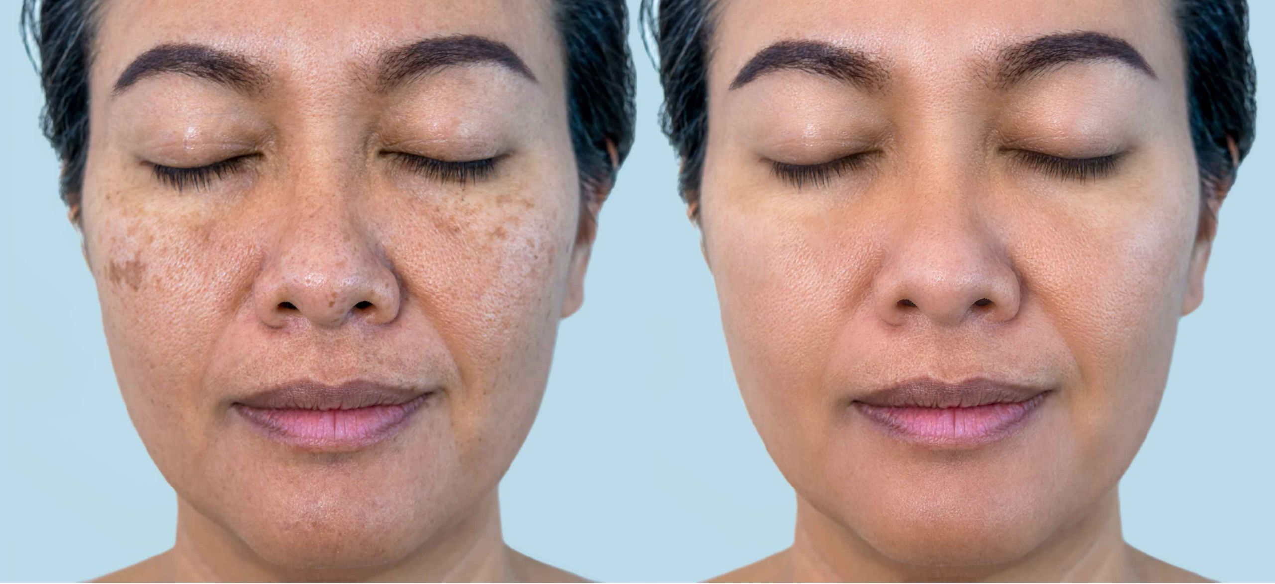 Melasma is the most common cause of dark pigmentation, hence the nickname, Melasma Mustache. An increase or fluctuation of estrogen and progesterone can trigger pigment-producing cells that heighten melanin in areas like your face exposed to the sun.