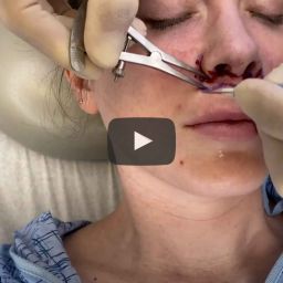 A lip lift procedure results in several positive outcomes. Patients experience improved definition along the border of their upper lip as well as the Cupid’s Bow.