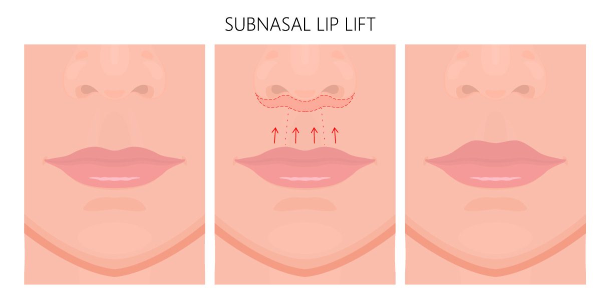 What happens during a lip lift?