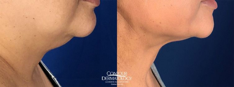 Face Liposculpture, 62-year-old woman, 6 months after