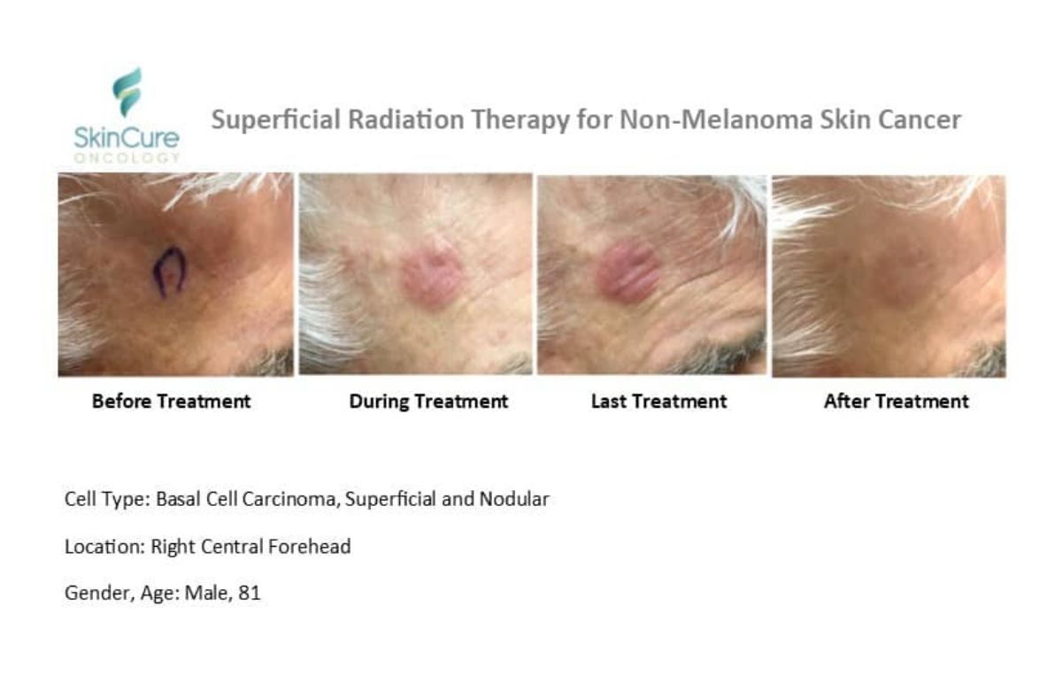 GentleCure IG-SRT Treatment on the forehead.
