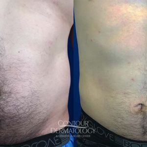 Liposuction Abdomen Male