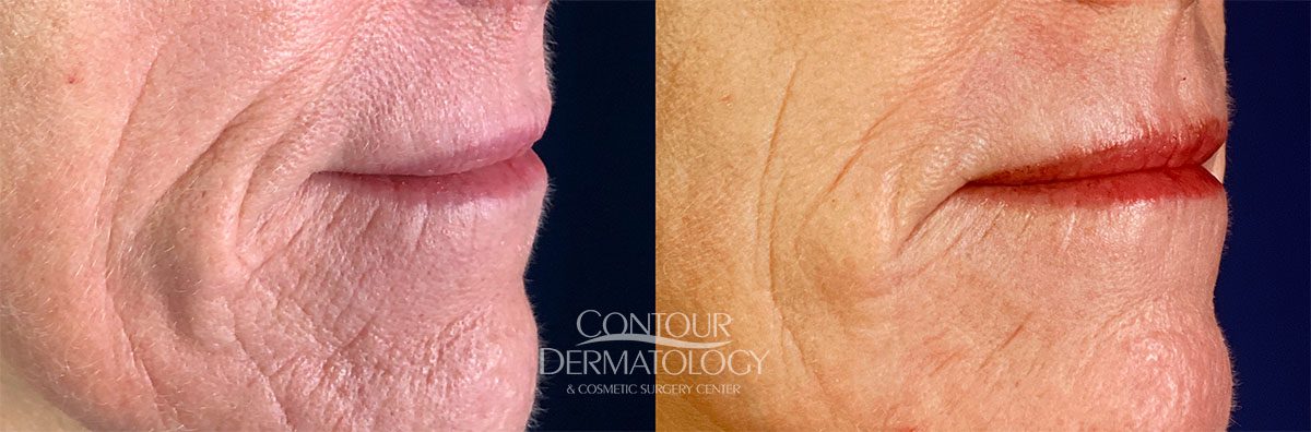 CO2 Fractional Laser Before & After - Glow Aesthetic Medicine